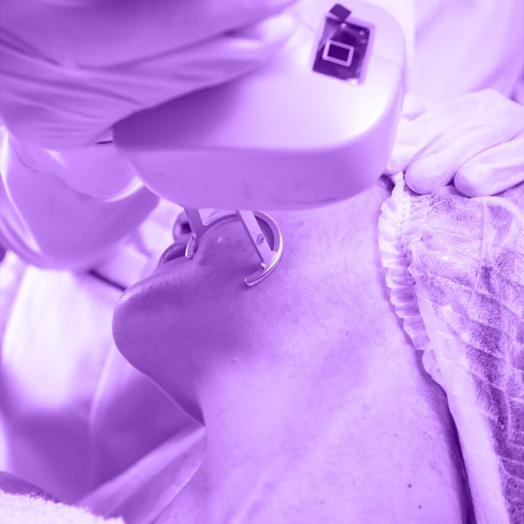 Clareamento de Manchas